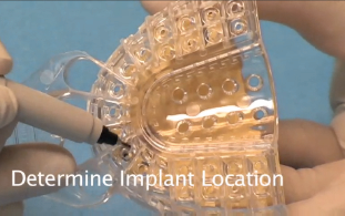 cBite Impress ske - determine implant location